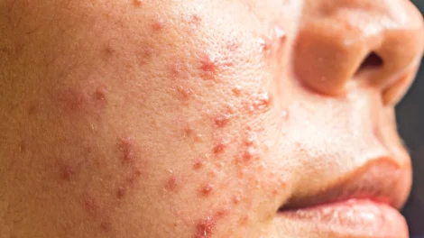 Causes, symptoms, treatment, prevention and skin care routine to get rid of cystic acne