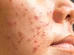Causes, symptoms, treatment, prevention and skin care routine to get rid of cystic acne