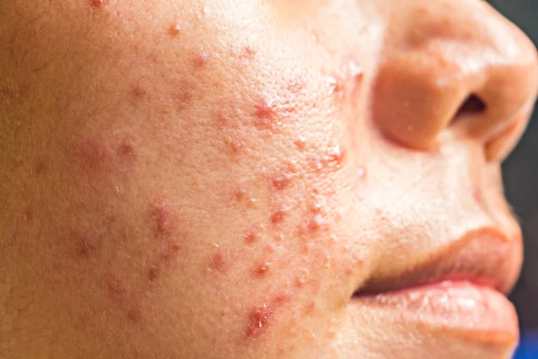 Causes, symptoms, treatment, prevention and skin care routine to get rid of cystic acne