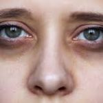 Dark circles under the eyes: Causes, types, prevention, treatment and DIY cream