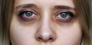 Dark circles under the eyes: Causes, types, prevention, treatment and DIY cream