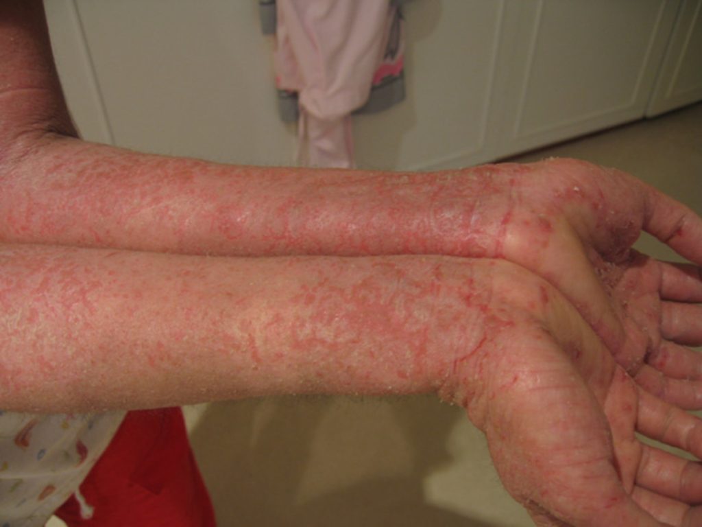 Dyshidrotic eczema is a type of eczema that affects the skin on the hands a