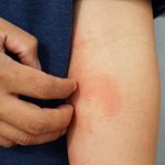 There are several different types of eczema, also known as atopic dermatitis, each with its own set of symptoms and characteristics.