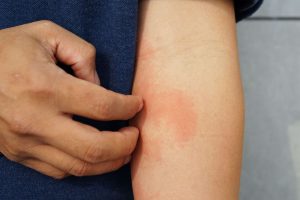 There are several different types of eczema, also known as atopic dermatitis, each with its own set of symptoms and characteristics.
