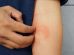 There are several different types of eczema, also known as atopic dermatitis, each with its own set of symptoms and characteristics.