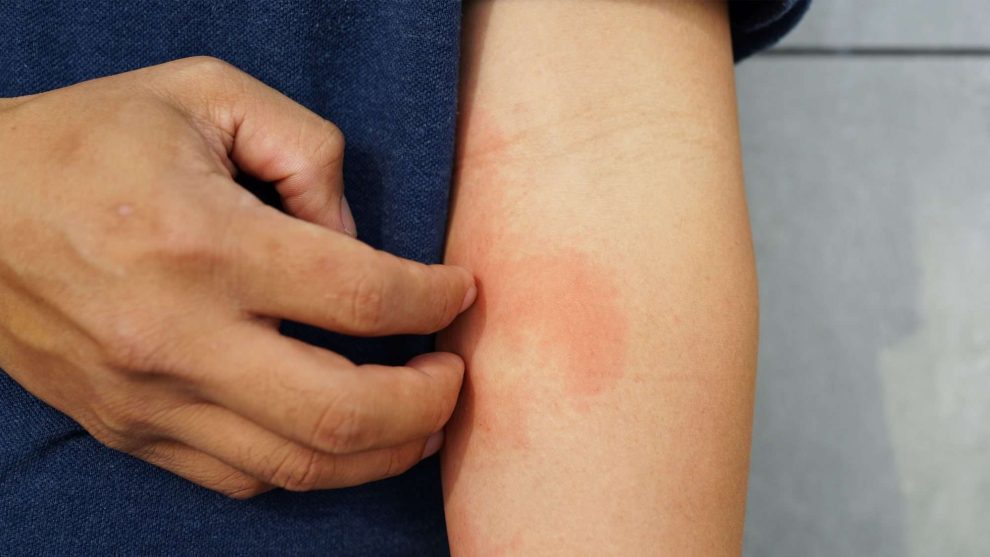 There are several different types of eczema, also known as atopic dermatitis, each with its own set of symptoms and characteristics.