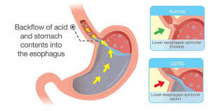 Heartburn: Causes, symptoms and treatment
