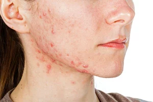 It is important to seek medical attention for hormonal acne as it can be difficult to treat with over-the-counter products alone.