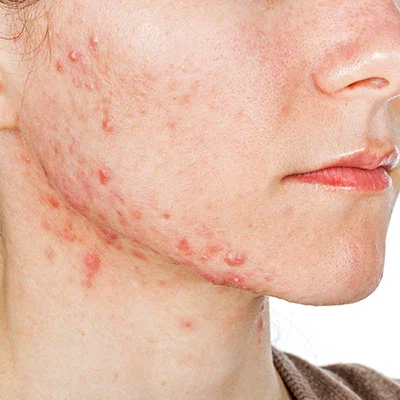 It is important to seek medical attention for hormonal acne as it can be difficult to treat with over-the-counter products alone.