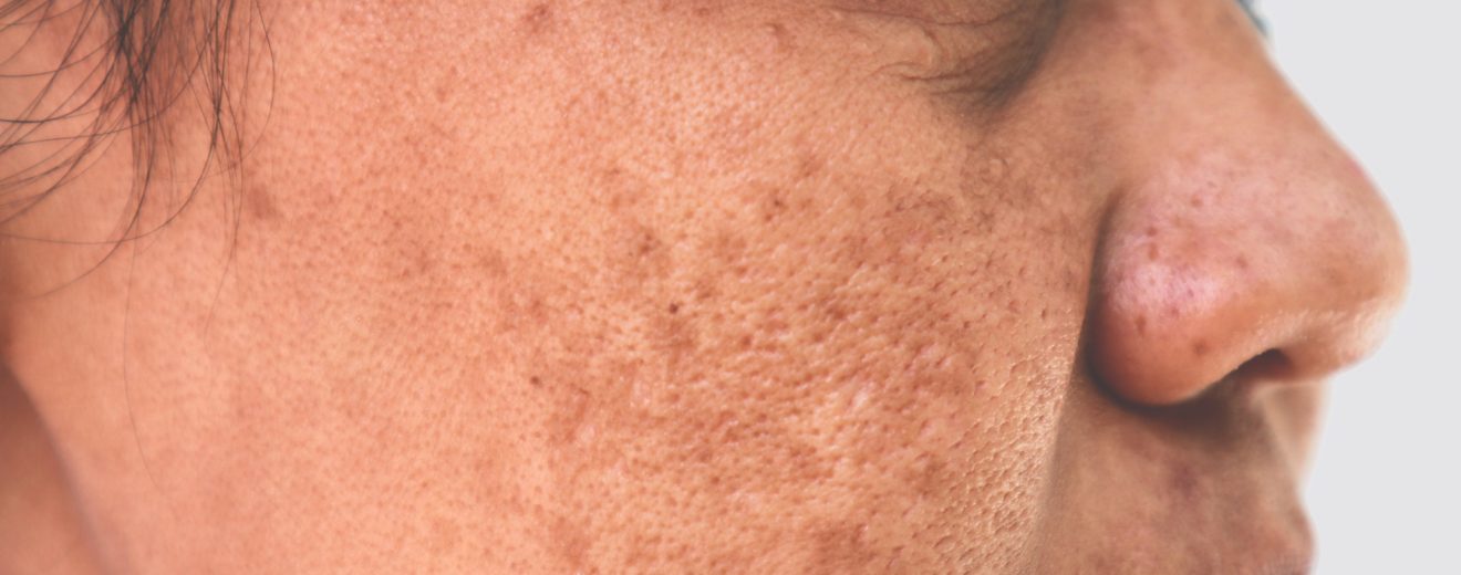 Causes, prevention and treatment for hyperpigmentation at home