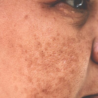 Causes, prevention and treatment for hyperpigmentation at home