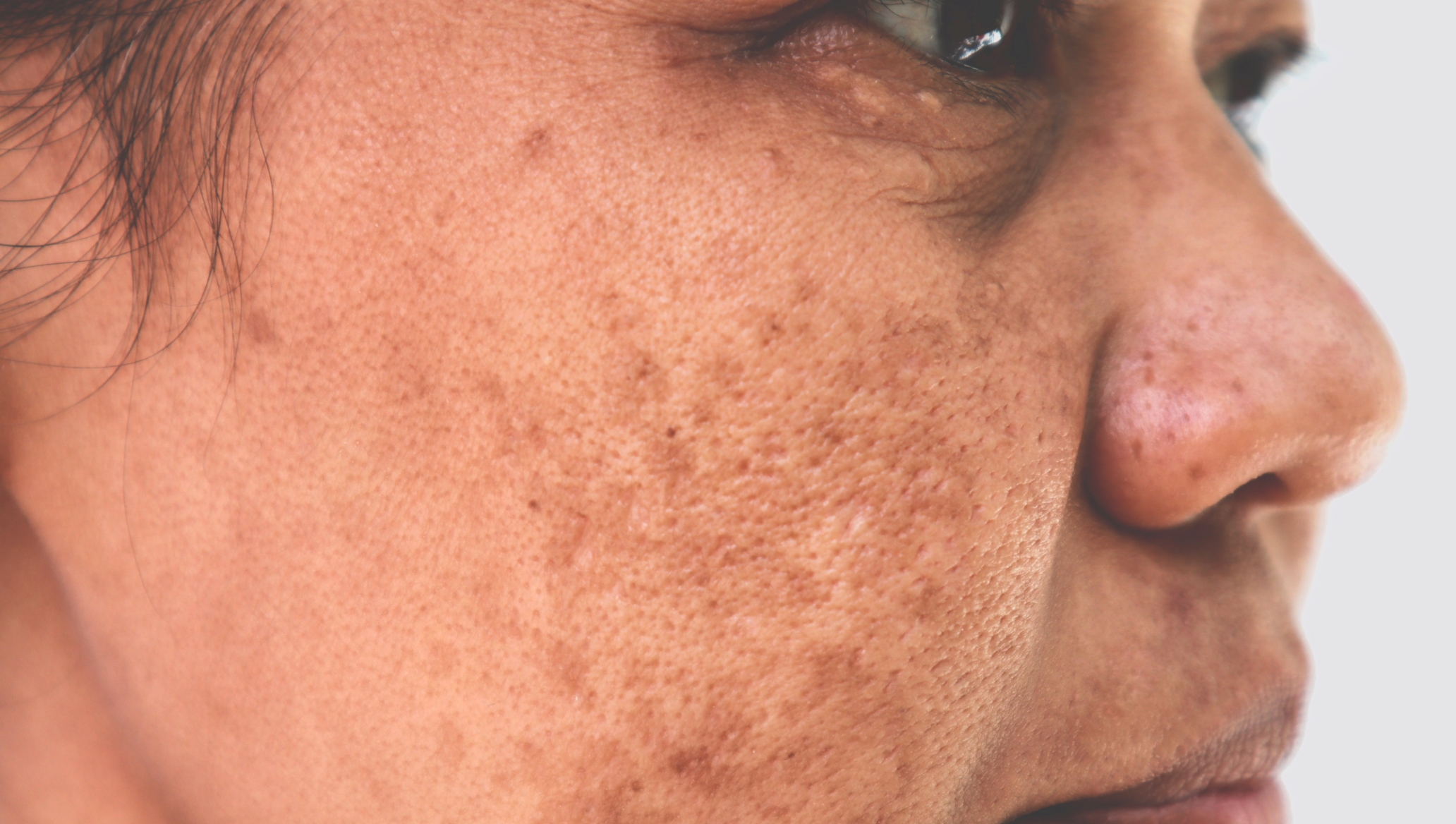 Causes, prevention and treatment for hyperpigmentation at home