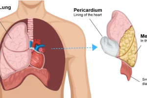 Mesothelioma cancer causes, symptoms and treatment