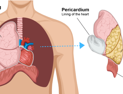 Mesothelioma cancer causes, symptoms and treatment
