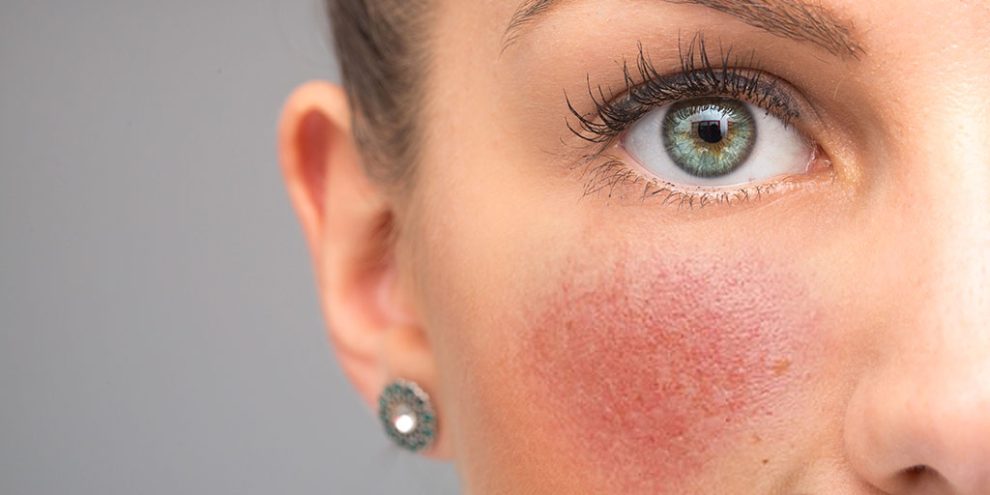 Rosacea, causes, symptoms, prevention and treatment