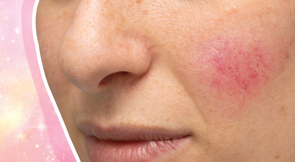 Rosacea is a chronic skin condition that causes redness and inflammation on the face, especially on the cheeks, nose, chin, and forehead. It 