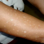White dots on skin