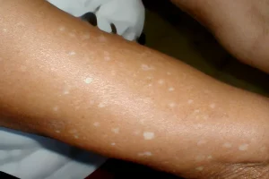 White dots on skin