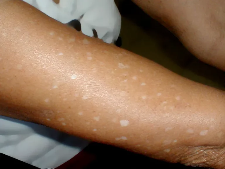 White dots on skin