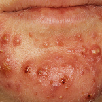 Causes, symptoms, types, prevention, treatment and home remedies of acne vulgaris.