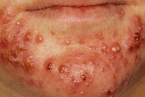 Causes, symptoms, types, prevention, treatment and home remedies of acne vulgaris.