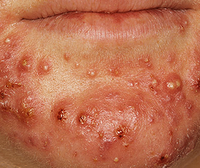 Causes, symptoms, types, prevention, treatment and home remedies of acne vulgaris.