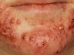 Causes, symptoms, types, prevention, treatment and home remedies of acne vulgaris.