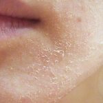 causes, symptoms, treatment and prevention of dry skin