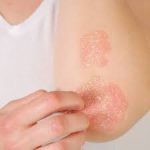 All about psoriasis
