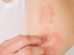 All about psoriasis