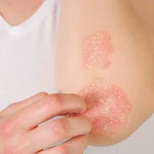 All about psoriasis