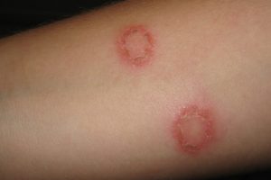 The name "ringworm" is misleading, as it is not caused by a worm, but by a fungus.
