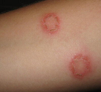 The name "ringworm" is misleading, as it is not caused by a worm, but by a fungus.