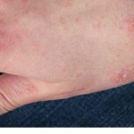 Types, causes, symptoms, prevention, treatment and home remedies of scabies.