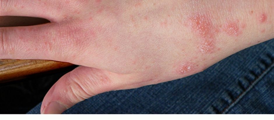 Types, causes, symptoms, prevention, treatment and home remedies of scabies.