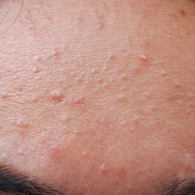 Causes, symptoms, treatment, prevention and home remedies