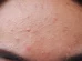 Causes, symptoms, treatment, prevention and home remedies