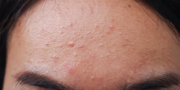 Causes, symptoms, treatment, prevention and home remedies