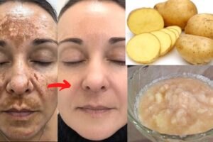 Everything about potato juice on face