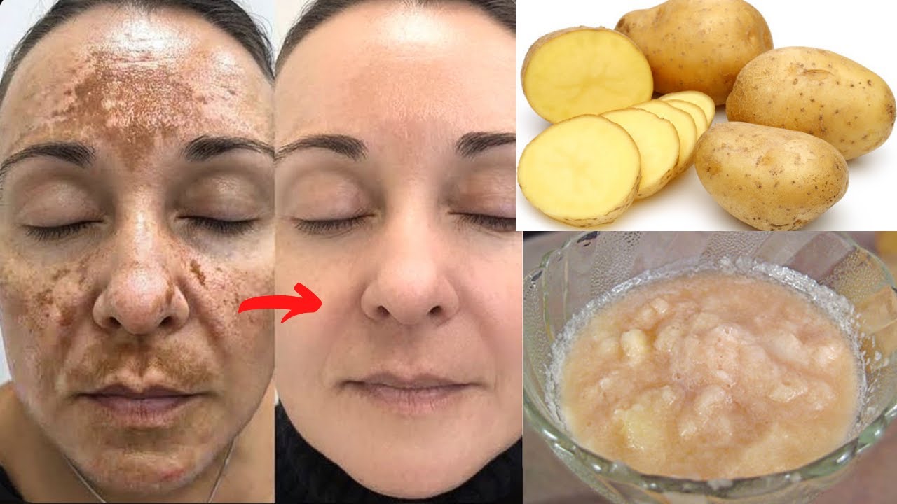 Everything about potato juice on face