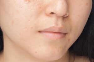 Textured Skin | Causes, Tips And Remedies