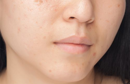 Textured Skin | Causes, Tips And Remedies