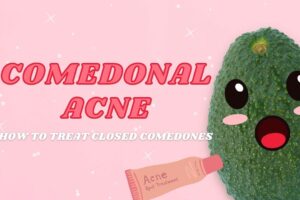 Comedones are a type of skin lesion commonly associated with acne