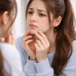 Chin acne often caused by stress, hormonal changes, and lifestyles.