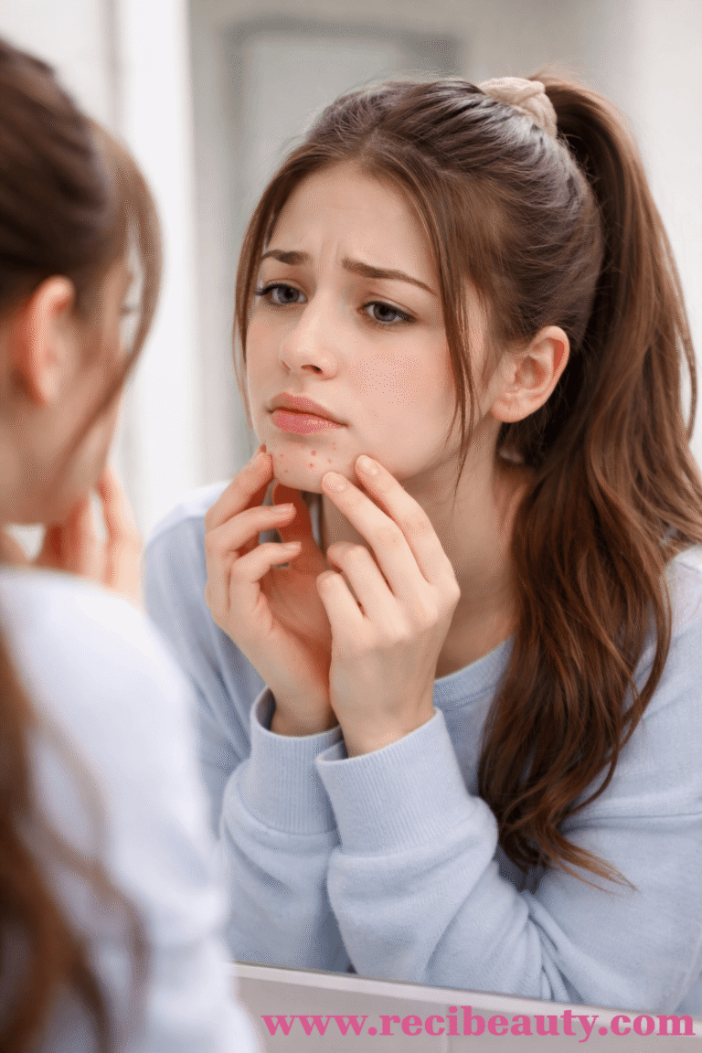 Chin acne often caused by stress, hormonal changes, and lifestyles.