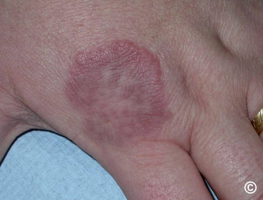 granuloma annulare creates a raised, bumpy ring that is red or reddish-purple. 