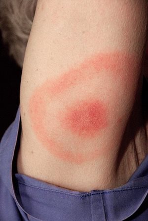 Lyme Disease looks like a target or a bullseye. 
