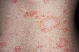 The initial patch of pityriasis rosea oval, scaly, and has a raised border.