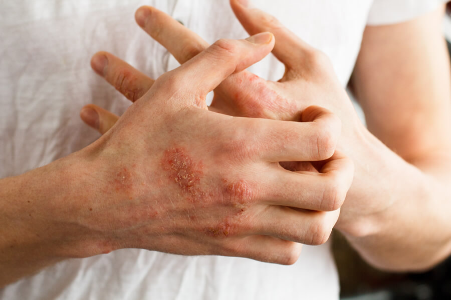 Psoriasis are usually covered in a thick, silvery-white scale