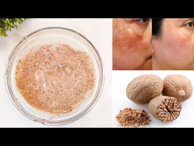  nutmeg is packed with anti-bacterial, anti-inflammatory and antioxidants that can easily help tackle acne breakouts, reduce pigmentation, dark spots, tighten pores and helps for skin whitening and glowing.